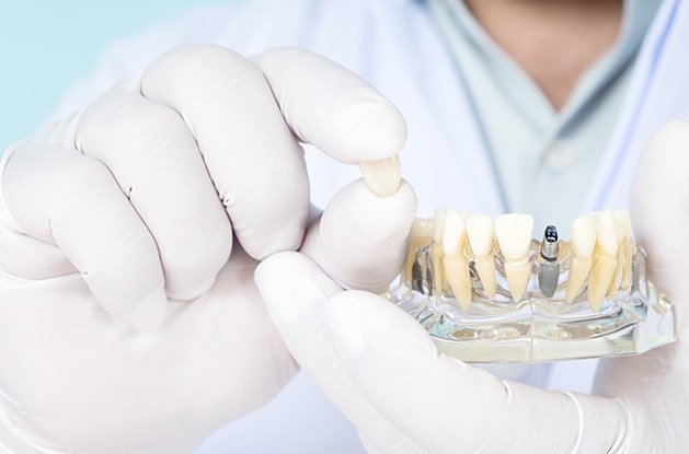 Dentist in white gloves showing sample dental implant