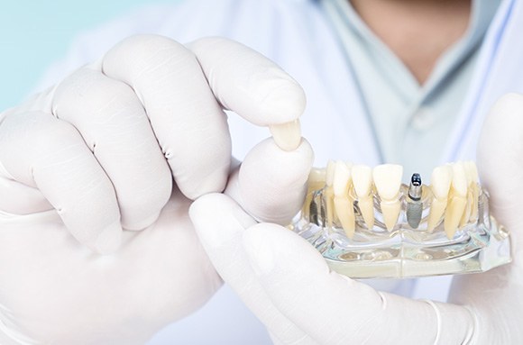 White gloved hands holding model dental implant and dental crown in other hand