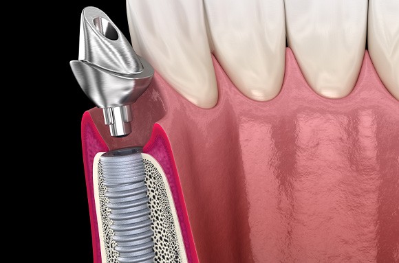 A 3D illustration of a placed dental implant and its abutment