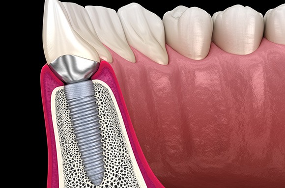 A 3D illustration of a dental implant with its final restoration