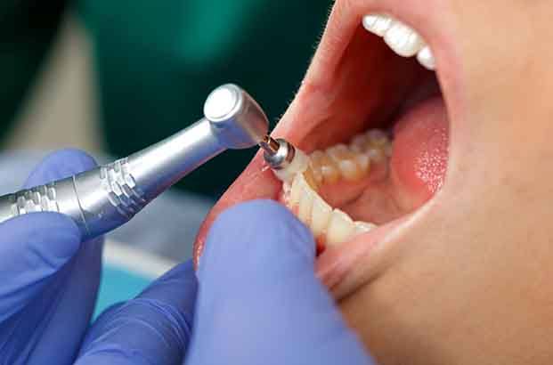 Patient’s teeth being polished by special dental brush