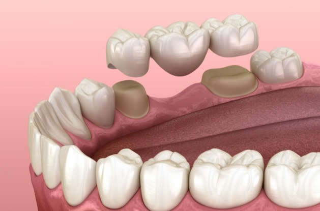 Illustrated dental bridge being fitted over two teeth to replace missing tooth between them