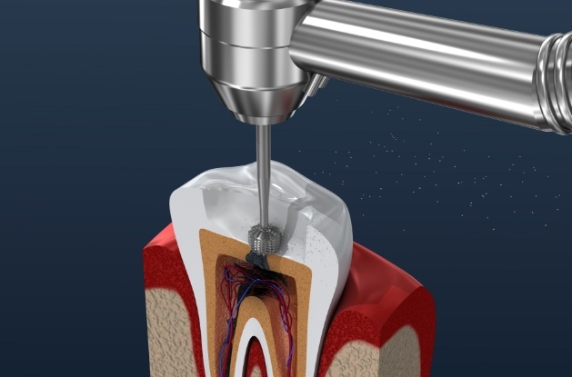 Illustrated dental tool cleaning inside of tooth during root canal treatment