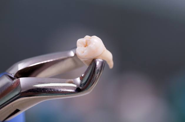 Silver forceps holding extracted tooth