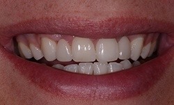 Smile with a complete row of upper teeth