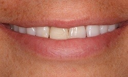 Close up of smile with slightly gapped teeth before dental treatment